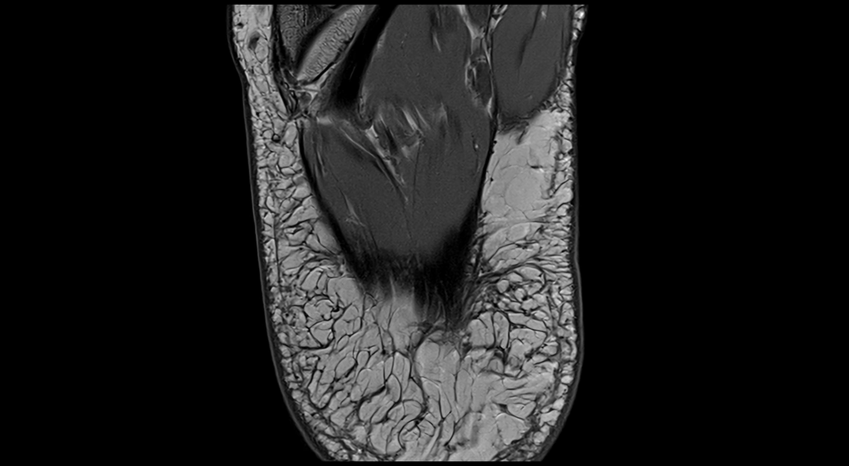MRI ankle ligaments anatomy axial 3T image 30.webp
